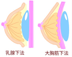人工乳房